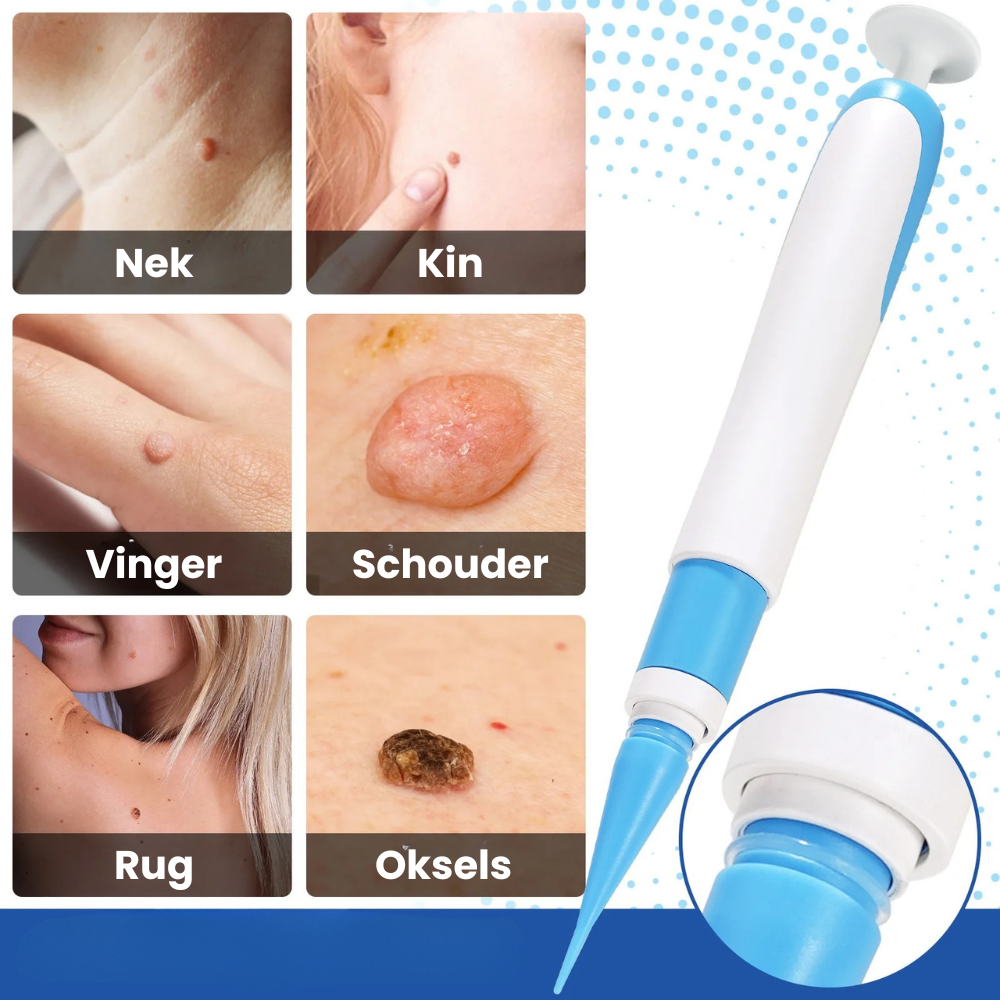 TagPen™ Go Kit | Binnen 5 tot 10 dagen van steelwratjes af | 50% korting