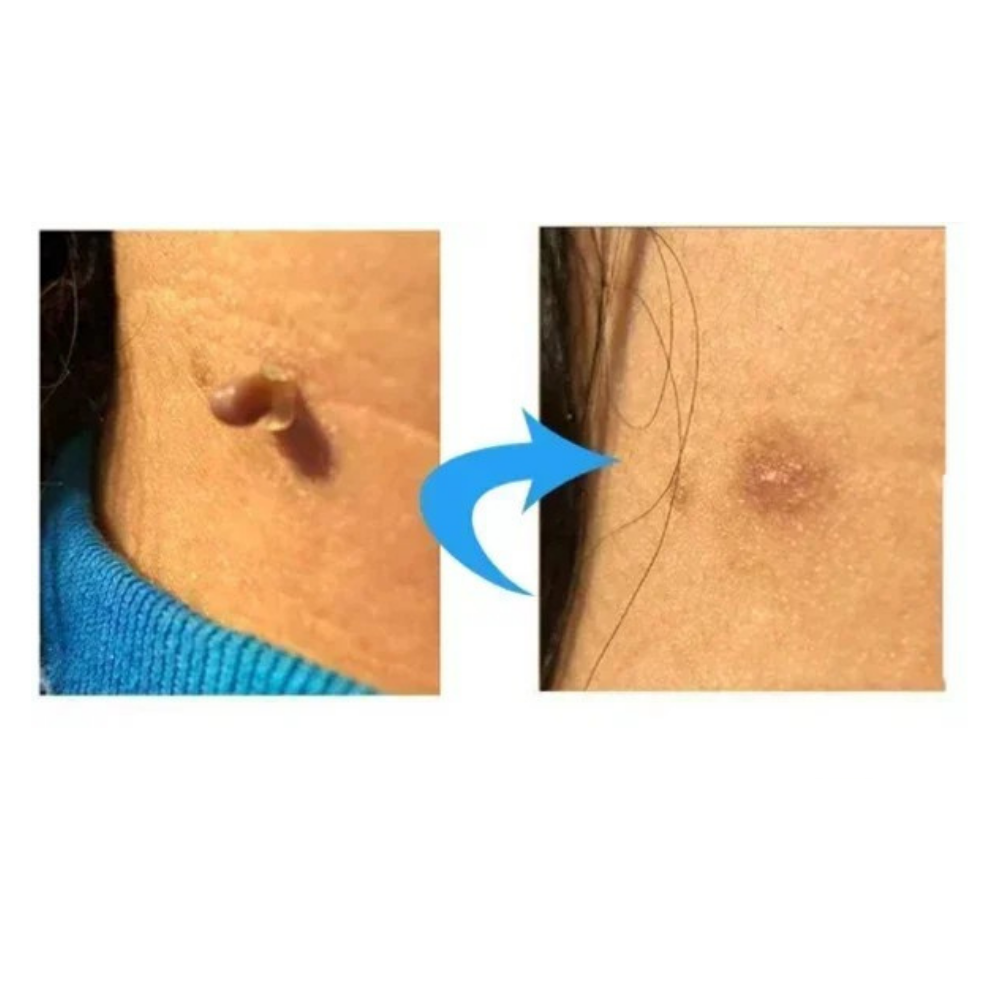 TagEase™ Kit | Verwijder steelwratjes zonder doktersafspraak | 50% korting