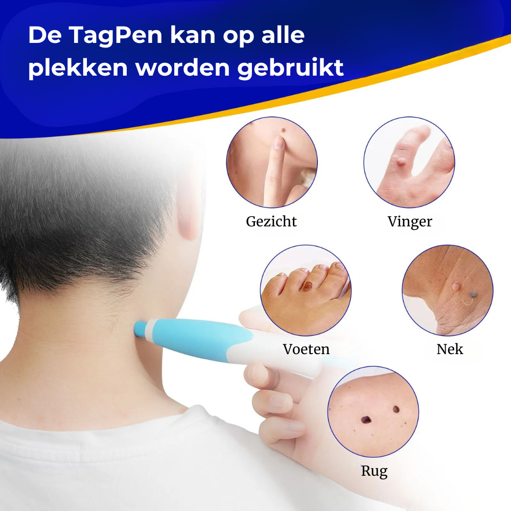 TagPen™ Kit | Verwijder steelwratjes gemakkelijk vanuit huis | 50% korting