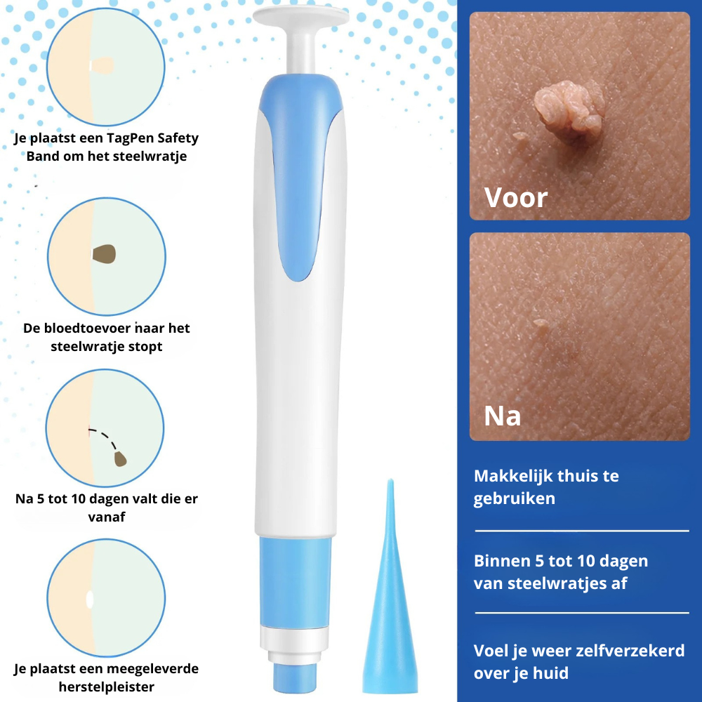 TagPen™ Go Kit | Binnen 5 tot 10 dagen van steelwratjes af | 50% korting