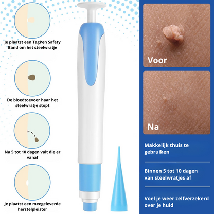 TagPen™ Go Kit | Binnen 5 tot 10 dagen van steelwratjes af | 50% korting