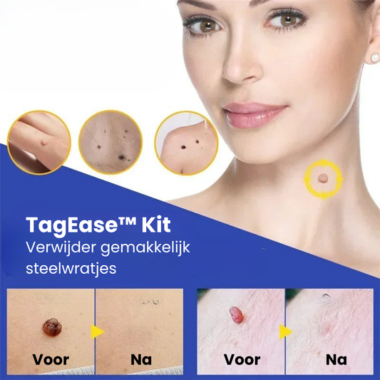 TagEase™ Kit | Verwijder steelwratjes zonder doktersafspraak | 50% korting