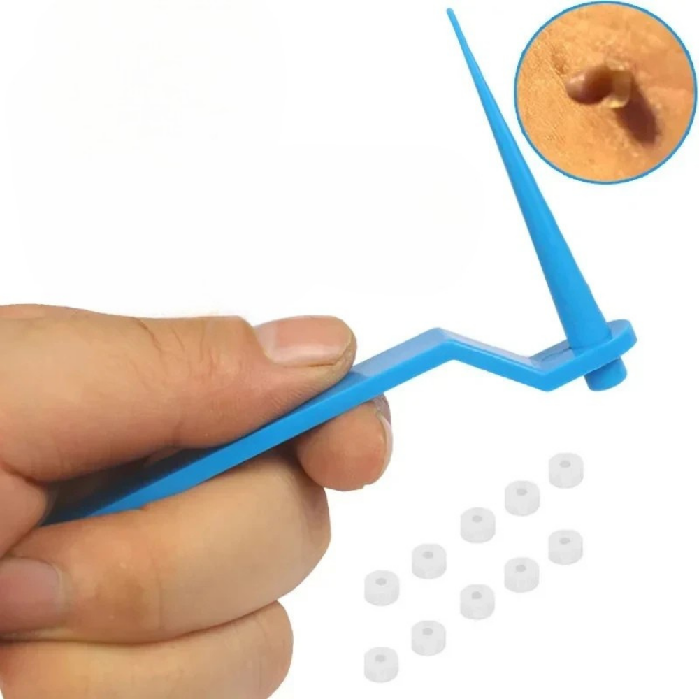 TagEase™ Kit | Verwijder steelwratjes zonder doktersafspraak | 50% korting