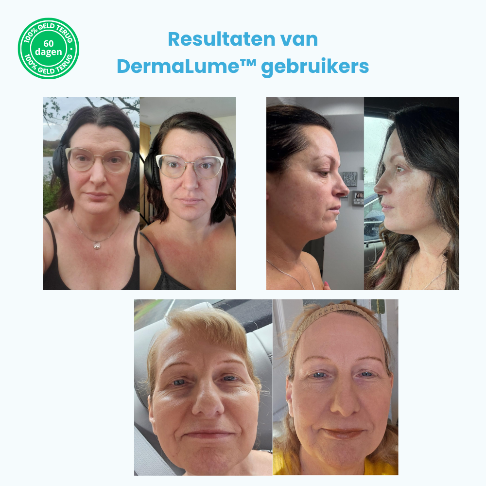 DermaLume™ | lift je gezicht en zie er 5 jaar jonger uit | 50% korting