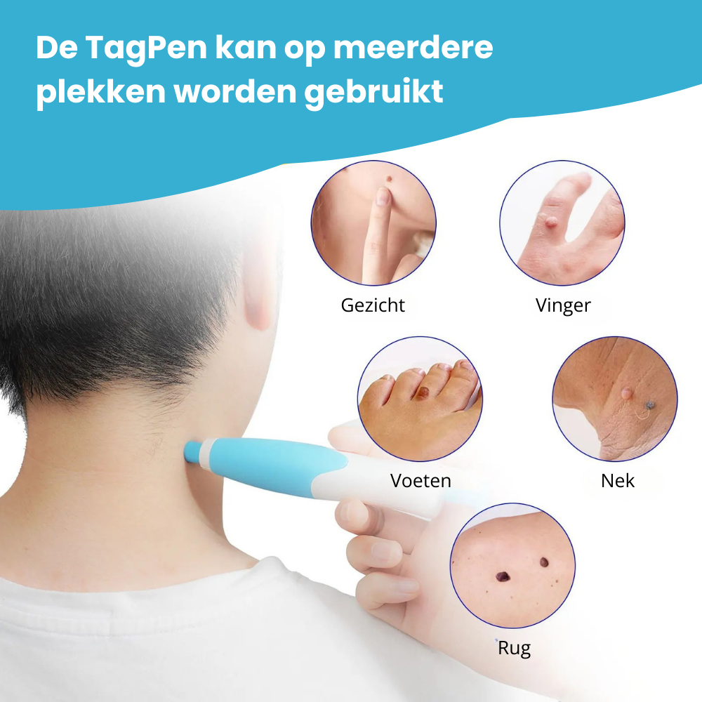 TagPen™ Kit | Verwijder steelwratjes veilig en gemakkelijk thuis | 50% korting
