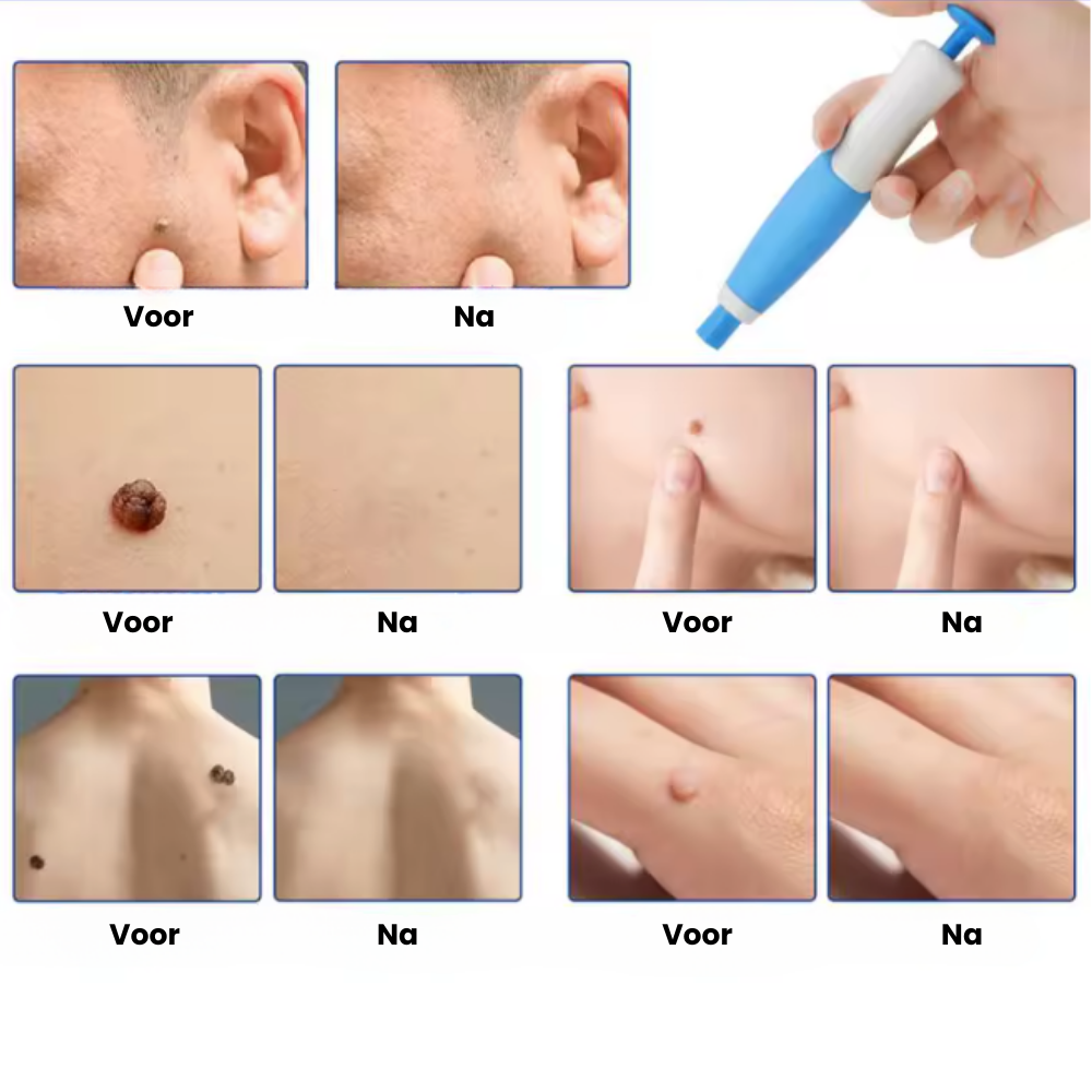 TagPen™ Kit | Verwijder steelwratjes gemakkelijk vanuit huis | 50% korting