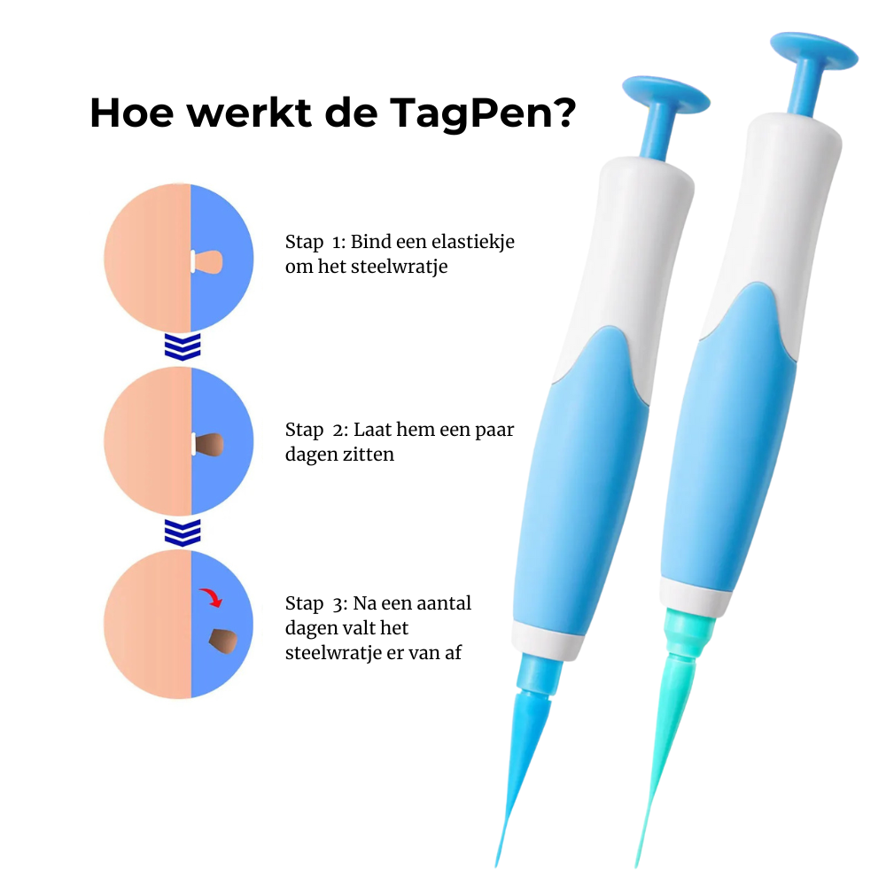 TagPen™ Kit | Verwijder steelwratjes gemakkelijk vanuit huis | 50% korting