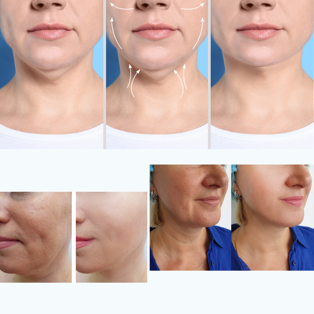 HailiCare™ | Je onderkin zichtbaar strakker in 3 weken | 3+3 gratis