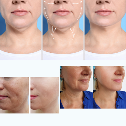 HailiCare™ | Je onderkin zichtbaar strakker in 3 weken | 3+3 gratis