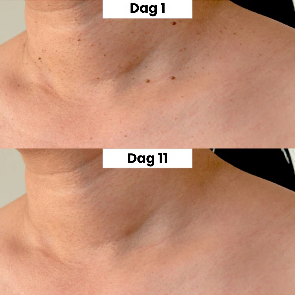 TagPen™ Kit | Verwijder steelwratjes veilig en gemakkelijk thuis | 50% korting