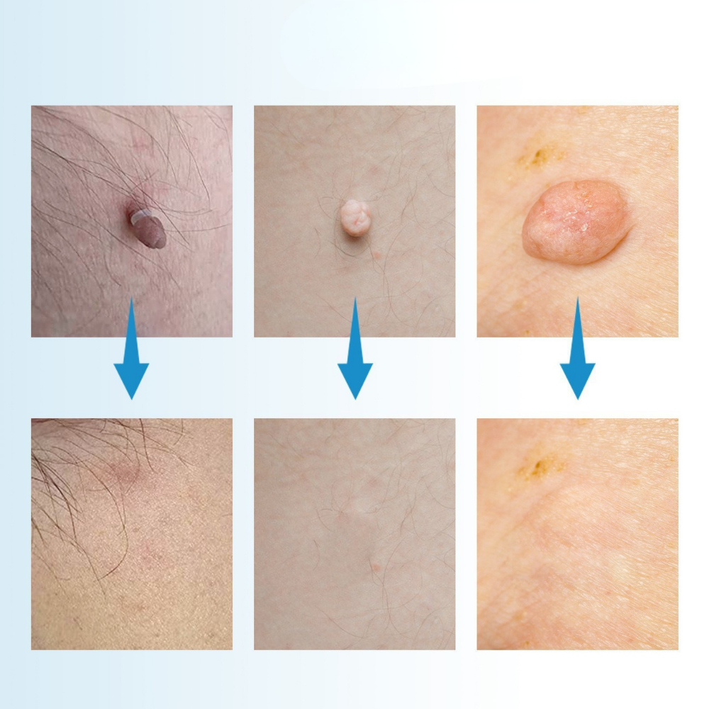 TagEase™ Kit | Verwijder steelwratjes zonder doktersafspraak | 50% korting