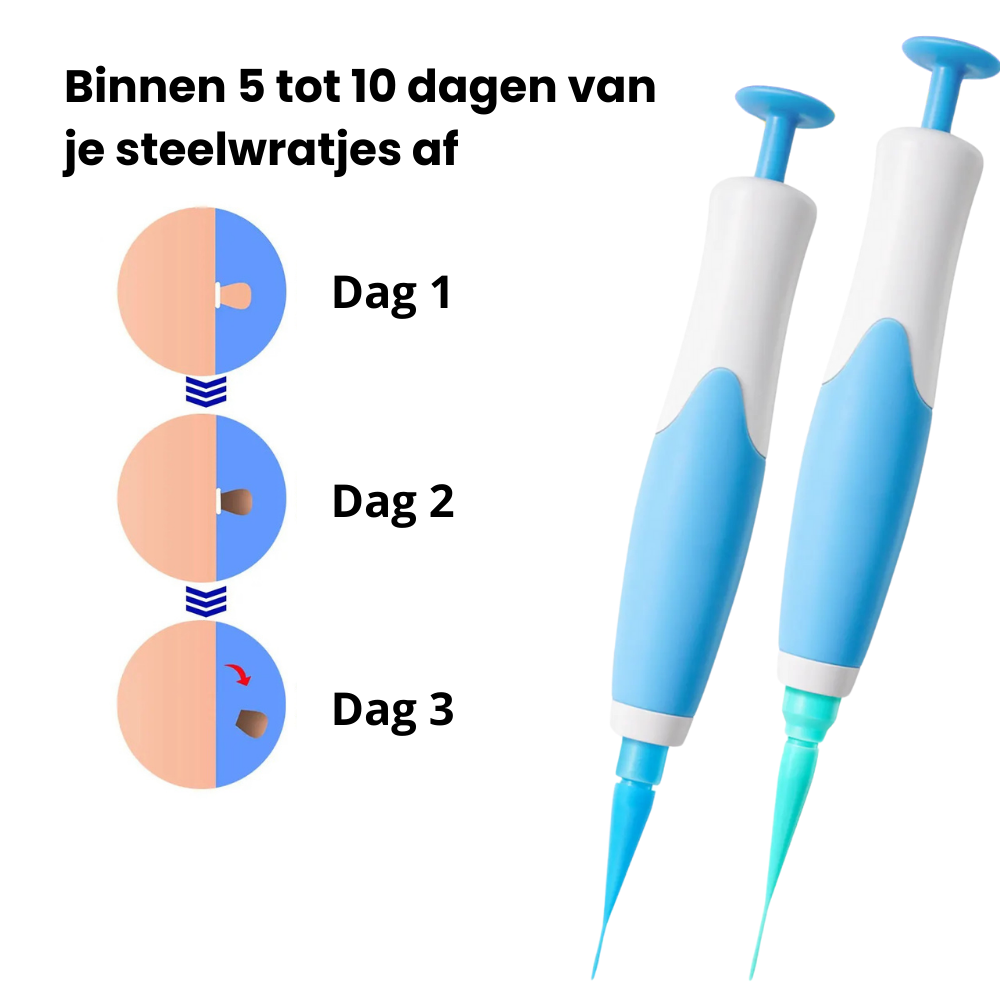 TagPen™ Kit | Verwijder steelwratjes veilig en gemakkelijk thuis | 50% korting