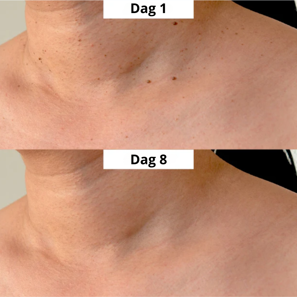 TagFree™ Kit | Voor iedereen die zich onzeker voelt over steelwratjes