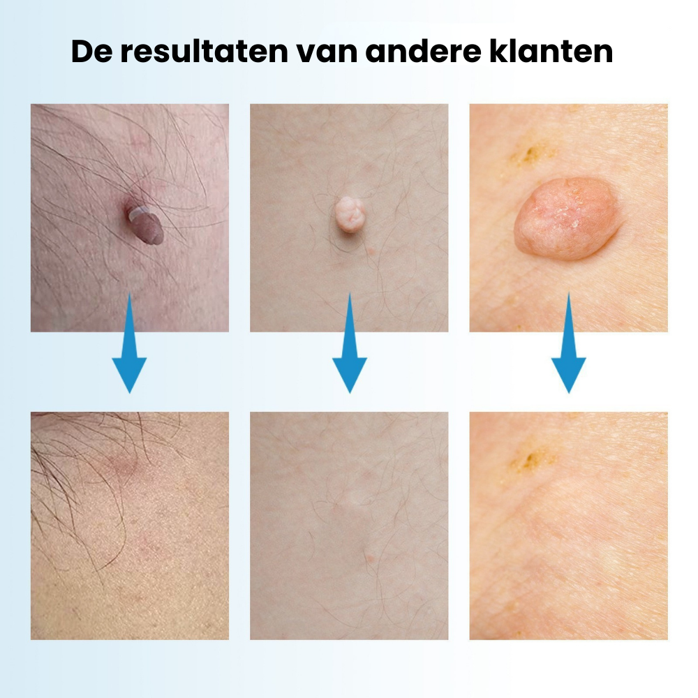 TagPen™ Kit | Verwijder steelwratjes veilig en gemakkelijk thuis | 50% korting