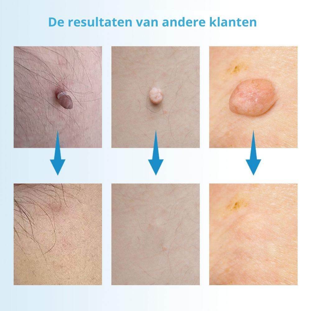 TagFree™ Kit | Voor iedereen die zich onzeker voelt over steelwratjes