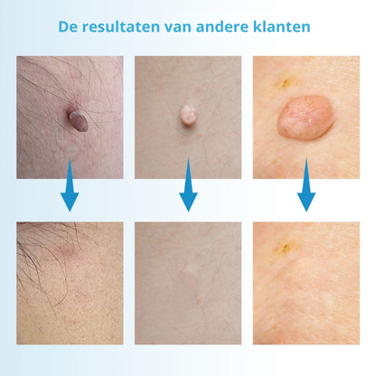 TagFree™ Kit | Voor iedereen die zich onzeker voelt over steelwratjes